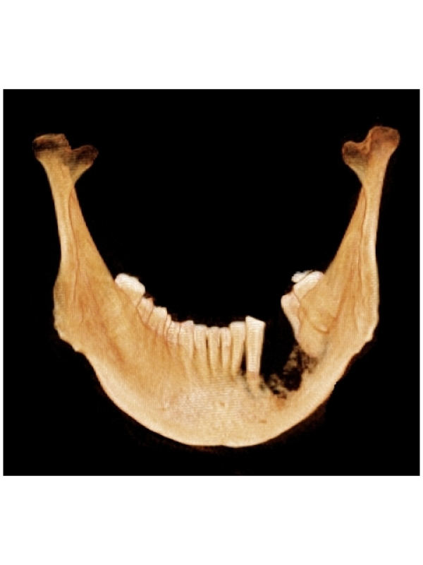 Bilateral Bifid Mandibular Condyles with Three Dimensional Reconstruction of CBCT Scan