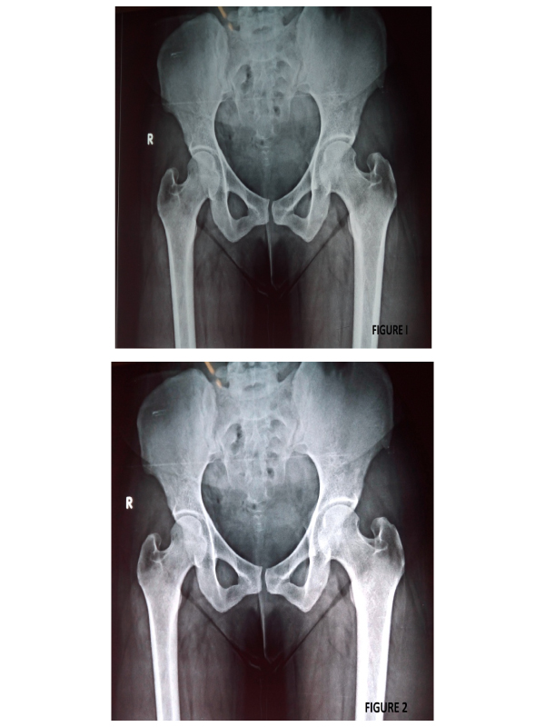 Symphysis Pubis Diastasis