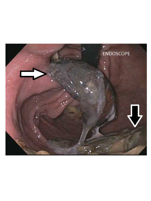 Intragastric Erosion of an Adjustable Gastric Band