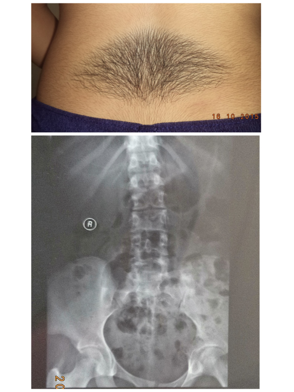 Nevoid Hypertrichosis Associated with Spina Bifida