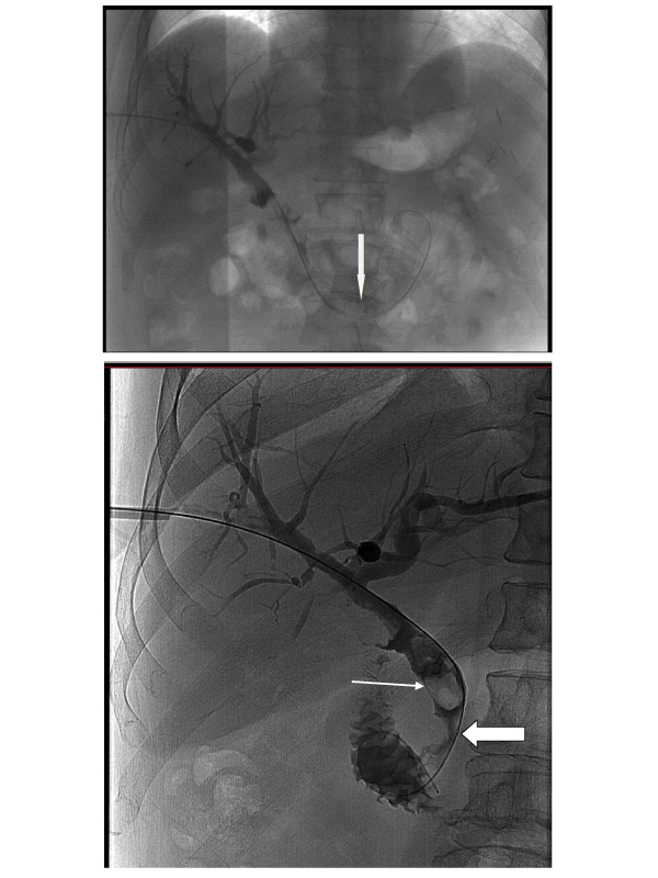 Lithotripsy of Biliary Calculi in a Complex Biliary Tract Using Endourologic Equipment
