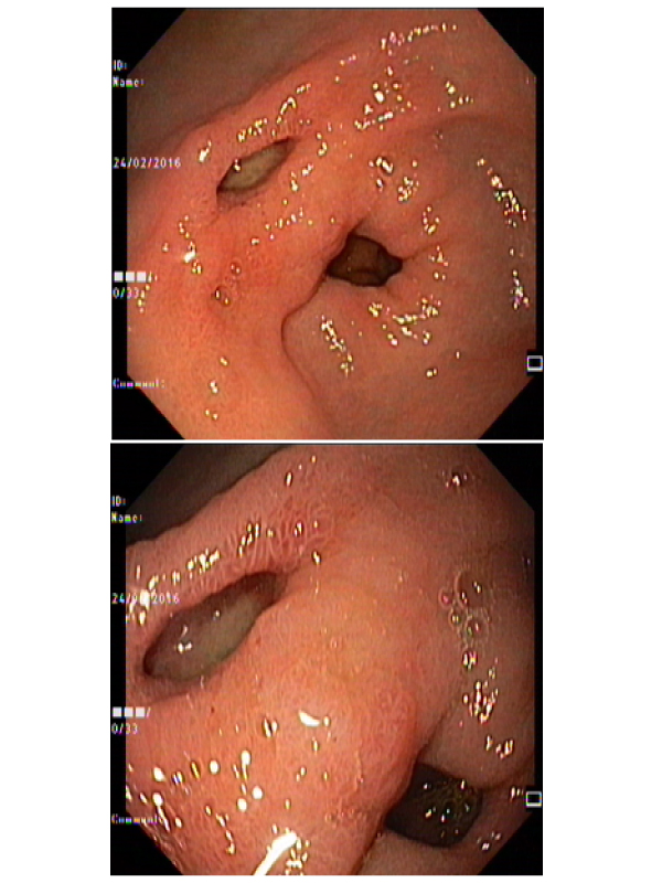 Double Pylorus Sign in a Cirrhotic: A Rare Endoscopic Finding