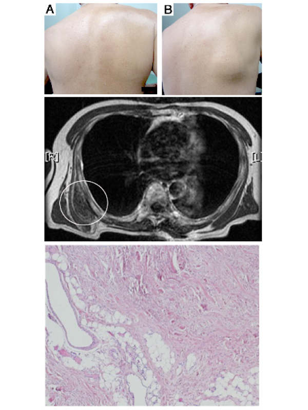 Elastofibroma Dorsi: A Subscapular Mass Appearing or Disappearing with Shoulder Motion