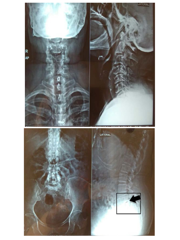 Spondylolisthesis Grade III