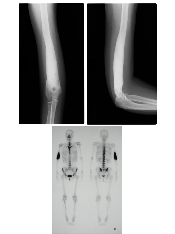 Sclerosing Osteomyelitis in the Long Bone