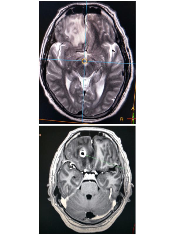 Neurocysticercosis