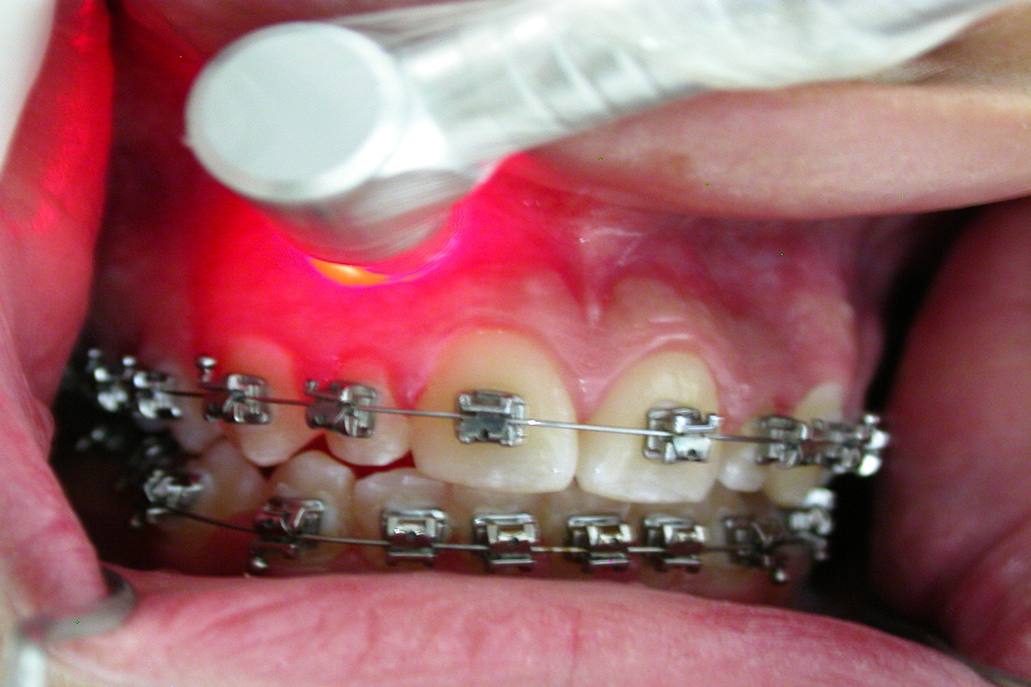 Orthodontics Therapy using Laser
