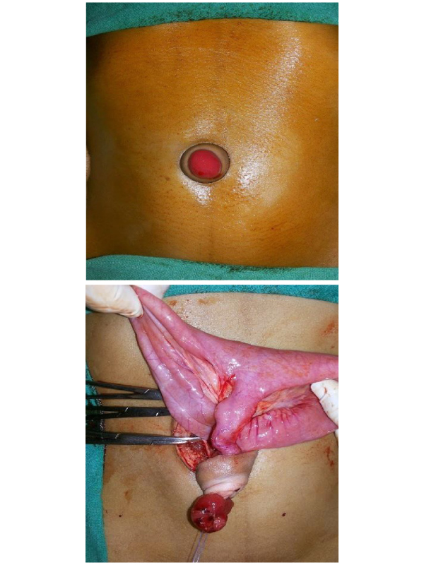 Umbilical Polyp with Patent Vitellointestinal Duct Mistaken as Umbilical Granuloma