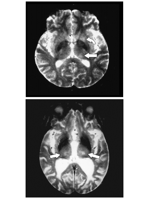 MRI Findings of the Japanese Encephalitis