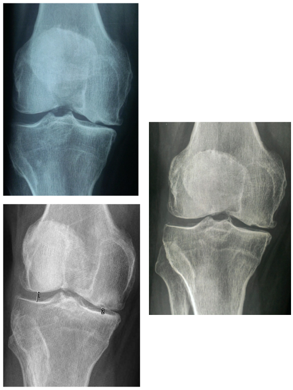 Effectiveness of Ozone in Osteoarthritis of the Knee