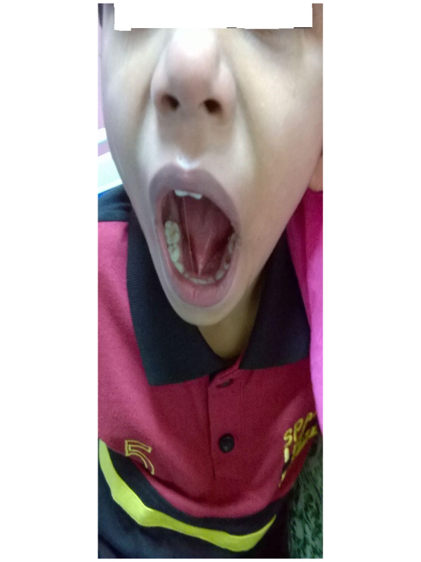 Tongue Tie/Ankyloglossia