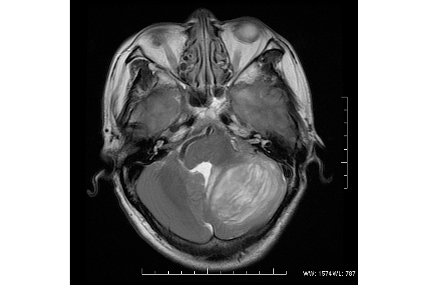 H-Mr Spectroscopy in Lhermitte–Duclos Disease: Axial T2-Weighted 