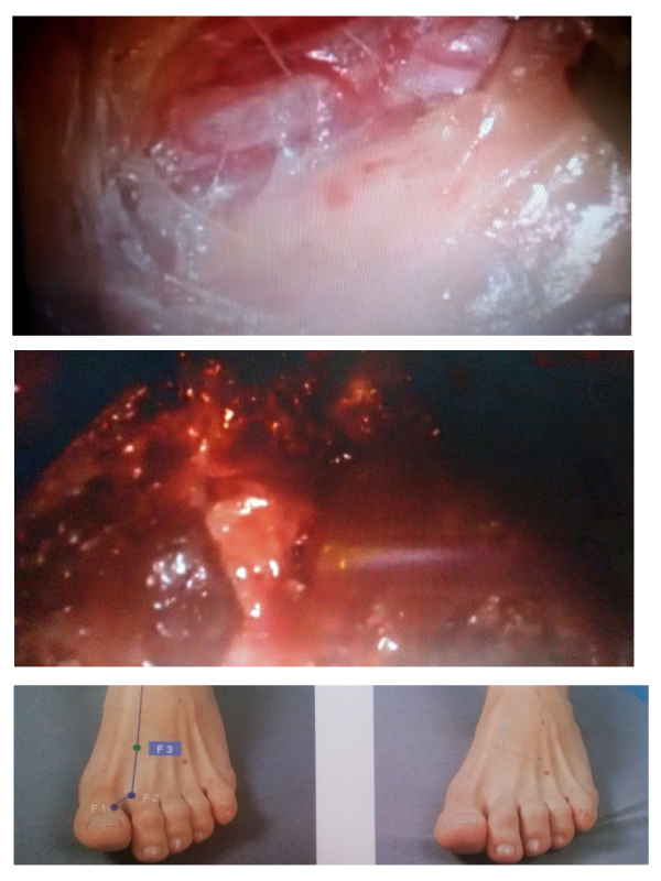 The Effect of Acupuncture in a Patient with Endometriosis