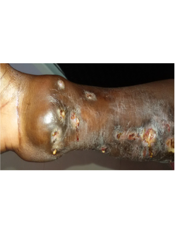 Mycetoma of the Upper Extremity: A Case Report