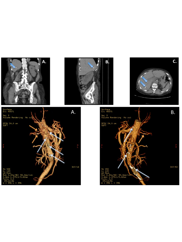 Intra-hepatic Atherosclerosis Disease: An Incidental Finding in Acute Abdominal Pain Patient