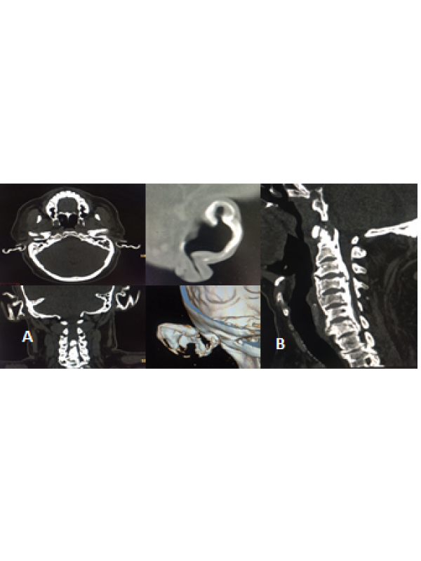 Petrified Ears or Calcified Pinnae