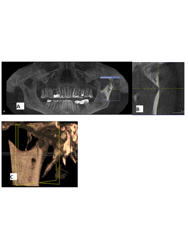 Parotid Stafne Defect