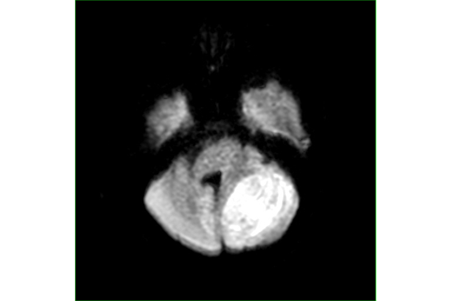 Assessment with MR Imaging: Diffusion-Weighted Image