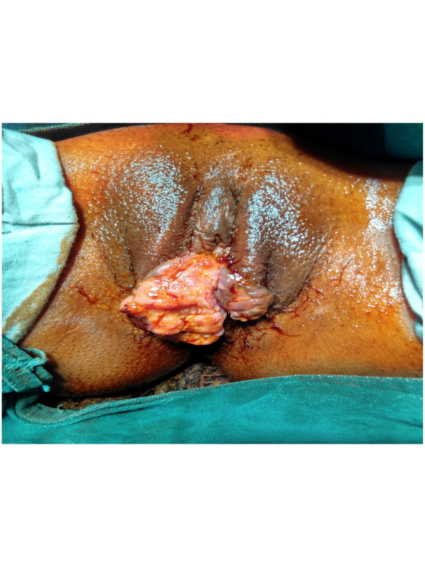 Vulval Tuberculosis Mimicking Malignancy ï¿½ A Diagnostic Dilemma