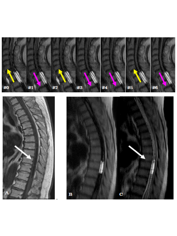 Time-SLIP Reveals Intramedullary Flow in Syringomyelia