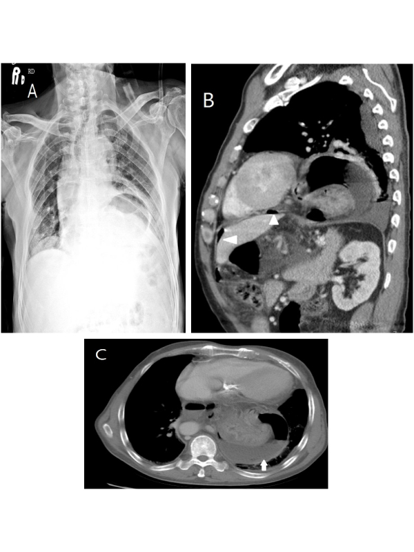 Perforated Gastric Ulcer in an Incarcerated Hiatal Hernia