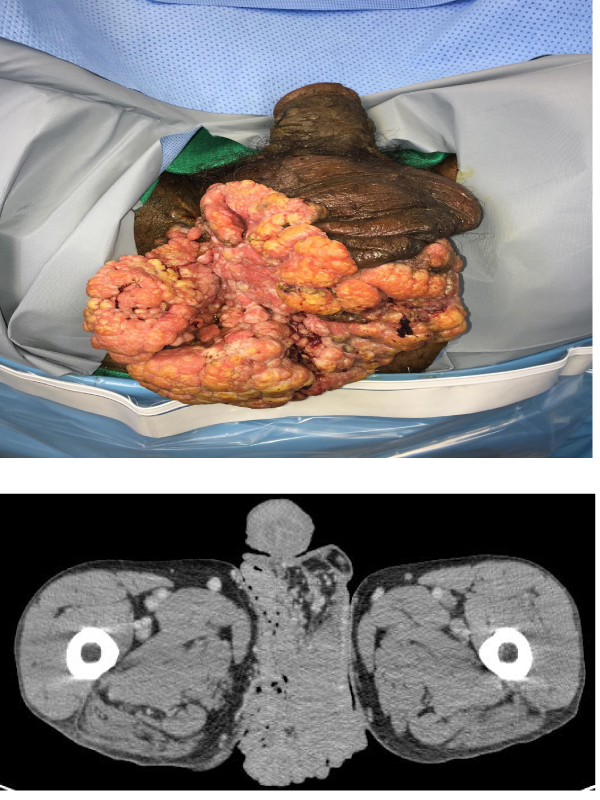 Massive Verrucous Squamous Cell Carcinoma of the Perineum