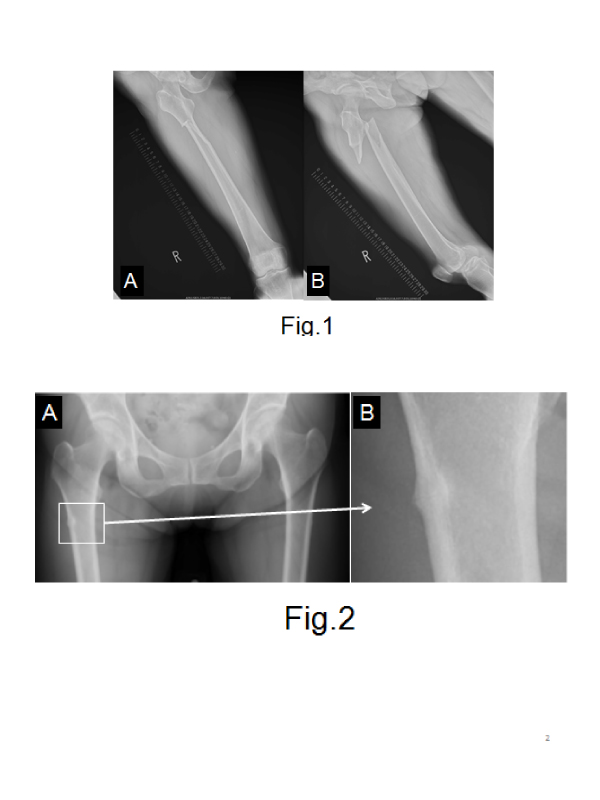 Atypical Femoral Fracture