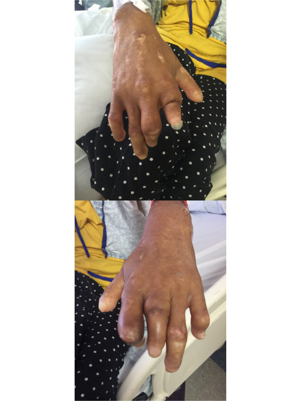 Skin Involvement in Systemic Sclerosis