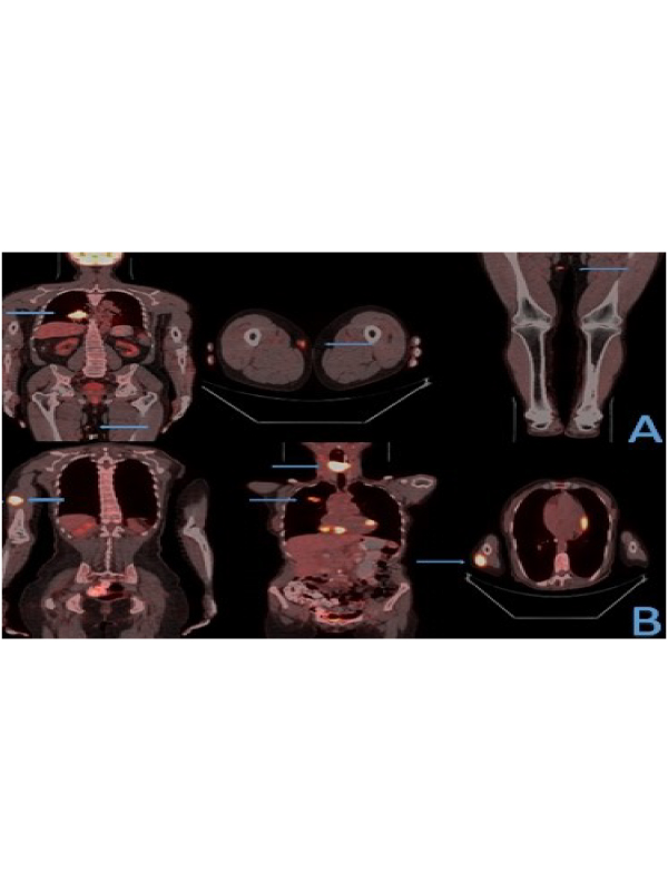 A Rare Metastasis of Lung Carsinoma Detected with PET/CT
