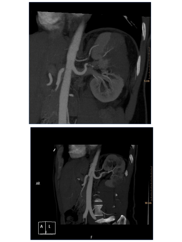 An Unusual Presentation of Fibromuscular Dysplasia