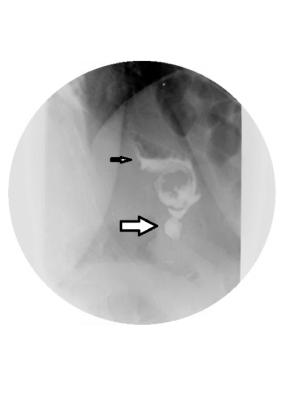 A Spiral Stomach after Vertical Sleeve Gastrectomy