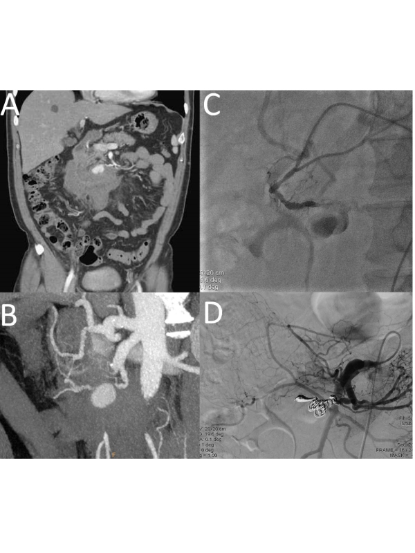 Transcatheter Embolization for Ruptured Aneurysm of Pancreaticoduodenal Artery