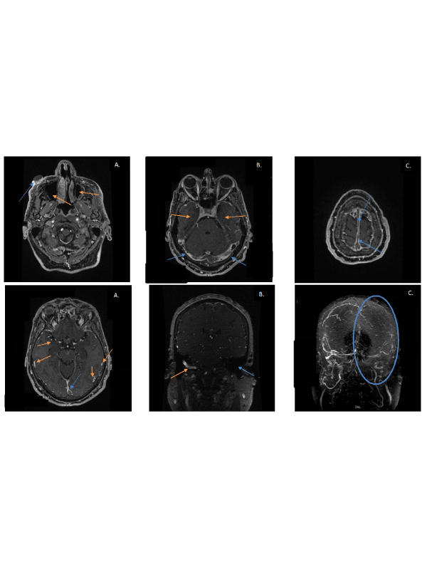 A Massive Cerebral Venous Thrombosis Secondary to Facial Cutaneous Coccidioidomycosis Lesion: A Rare Pattern Presentation