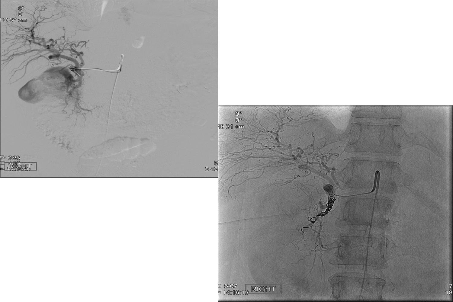 Transarterial Embolization for Upper Gastrointestinal Bleeding in a Patient with Prior Gastrododenal Artery Ligation