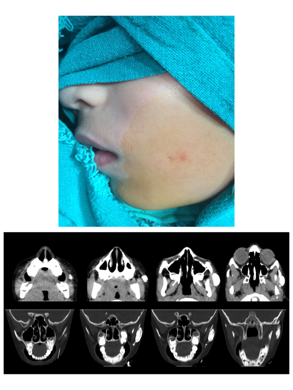 A Very Rare Case of First Branchial Cleft Sinus Outside Triangle of Triglia