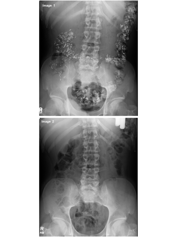 Numerous Sharp Foreign Body Ingestion and Spontaneous Expulsion Without any Complications