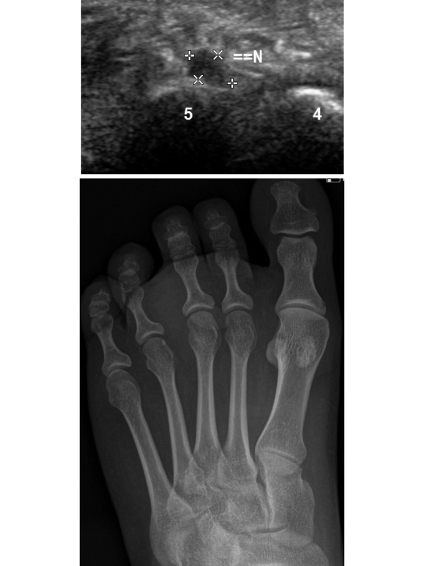 Ultrasonographic Assessment of the Foot Pseudotumoural Soft Tissue Lesions