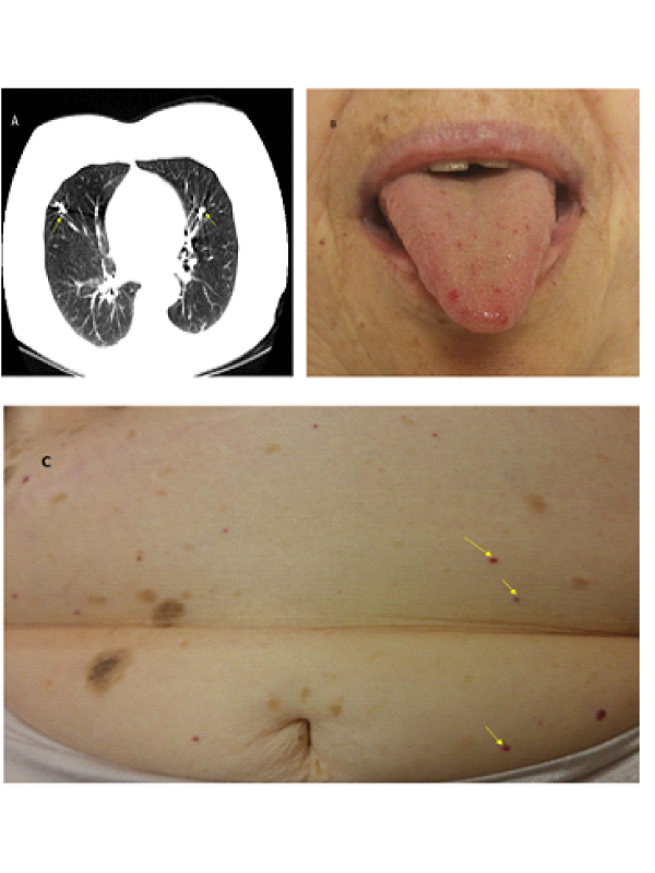 Recurrent Nasal Epistaxis, Osler-Weber-Rendu Syndrome