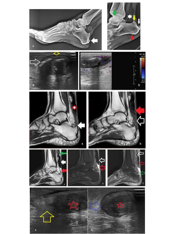 Atypical Presentation of Achilles Tendon Rupture: MRI Evaluation