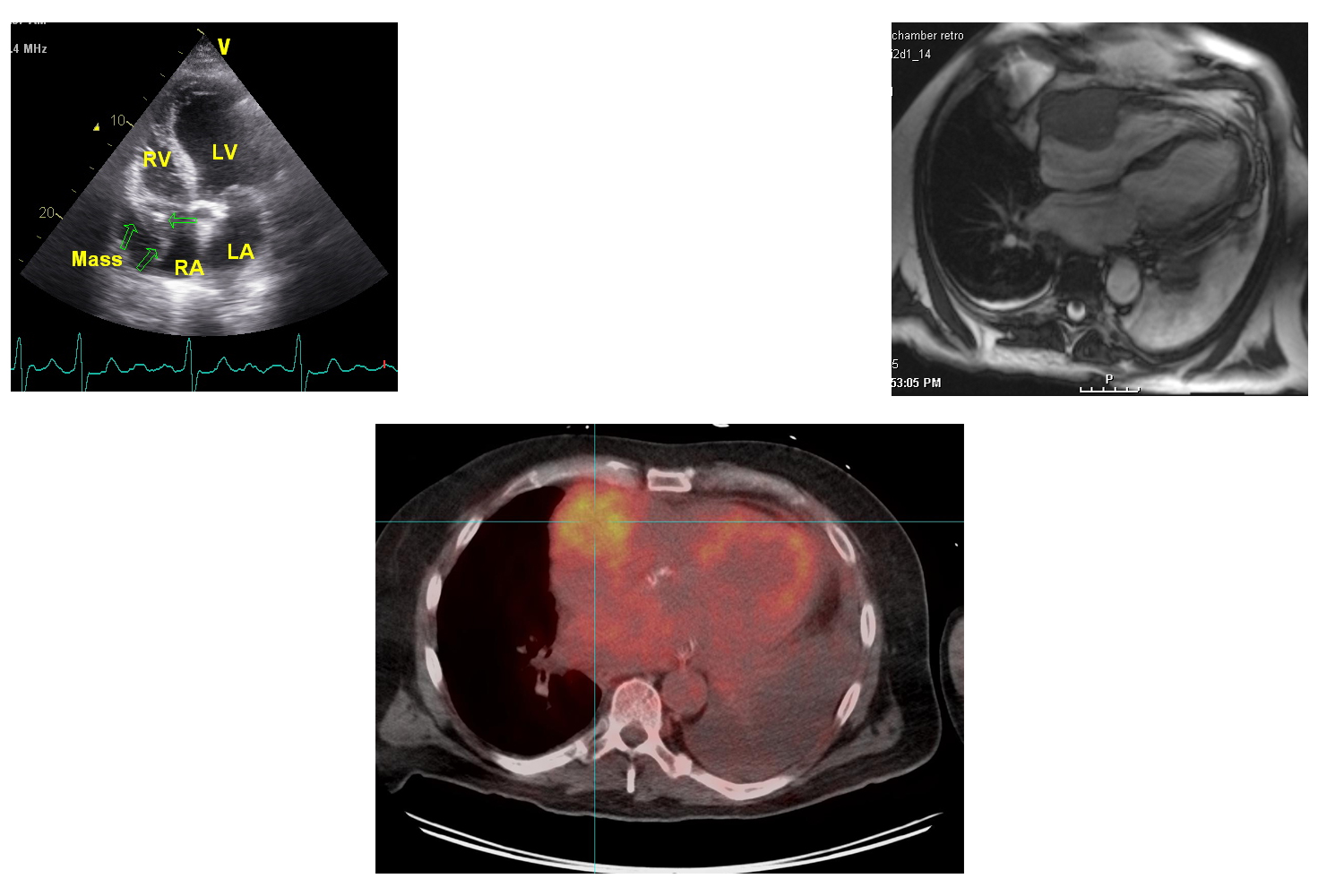 Atrial Mass in Multiple Myeloma – An Unusual Presentation