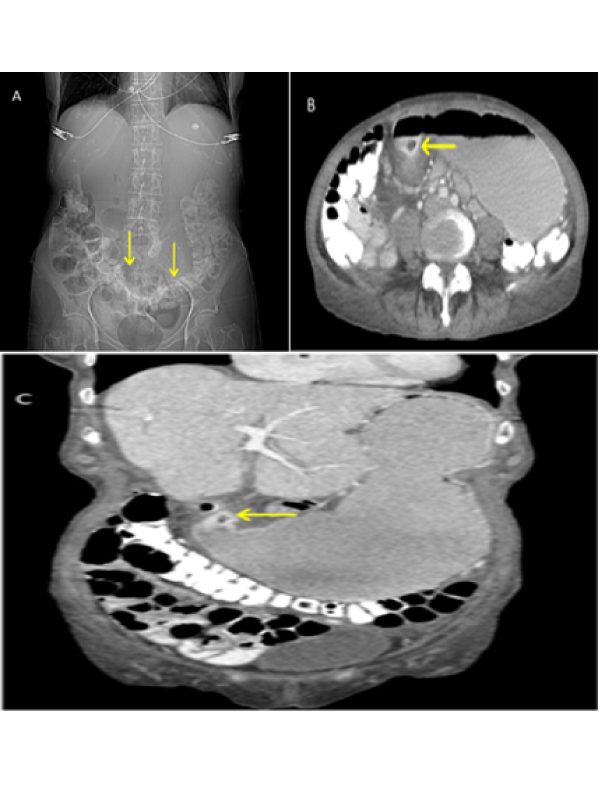 Gastric-Outlet Obstruction