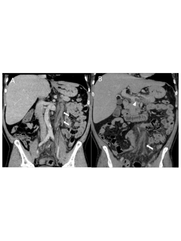 Inferior Mesenteric Vein Thrombosis