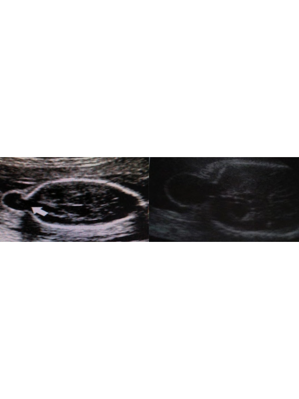 Occipital Cephalocele Characterized by Protrusion 0f Intracranial Structures through a Cranial Bone Defect