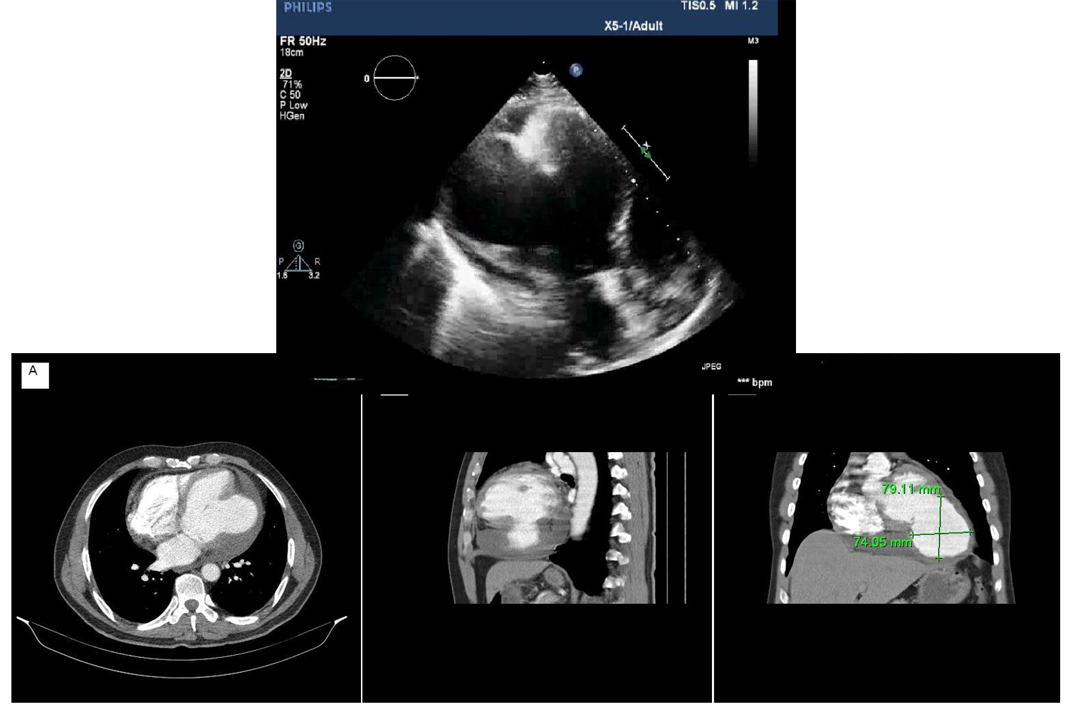 Giant Left Ventricular Pseudoaneurysm