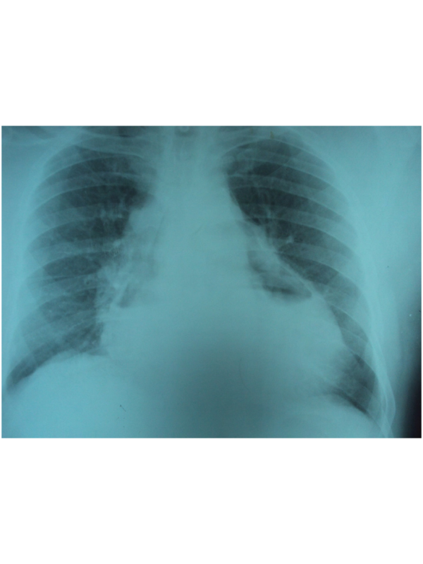 Hydropneumopericardium: Followed by Partial Pericardiectomy