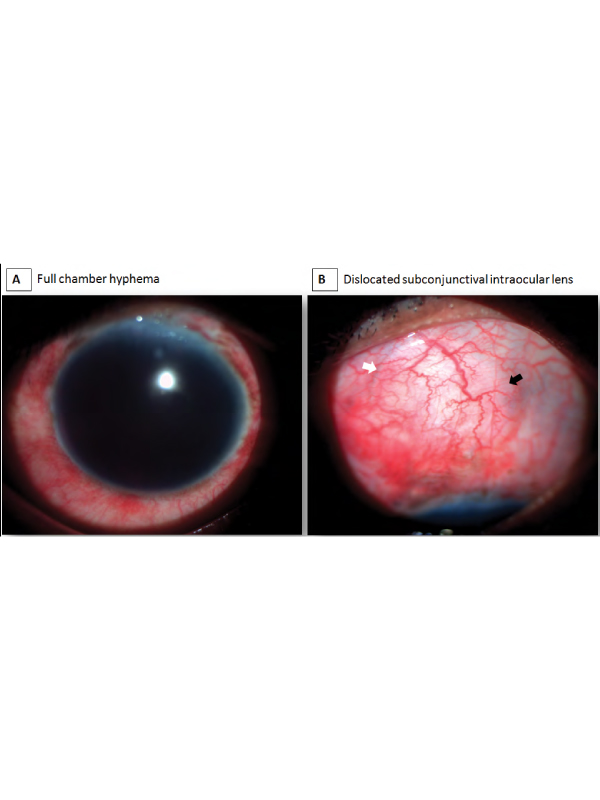 Traumatic Subconjunctival Dislocation of Intraocular Lens