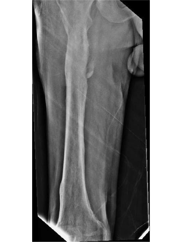 Involucrum - A Rare Pathological Entity of Chronic Osteomyelitis