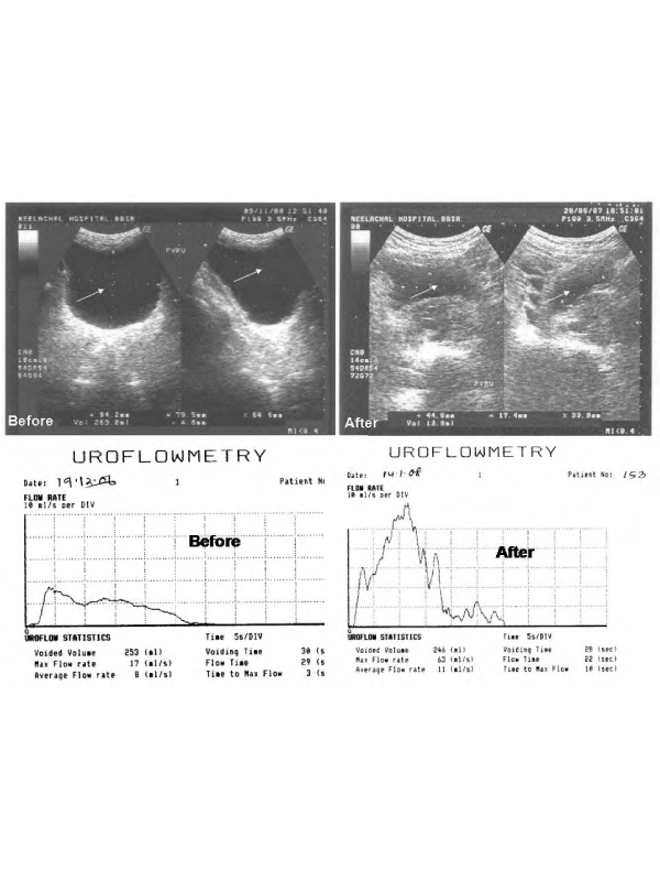 Combined Effects of Constitutional and Organopathic Homeopathic Medicines for Better Improvement of Benign Prostatic Hyperplasia Cases