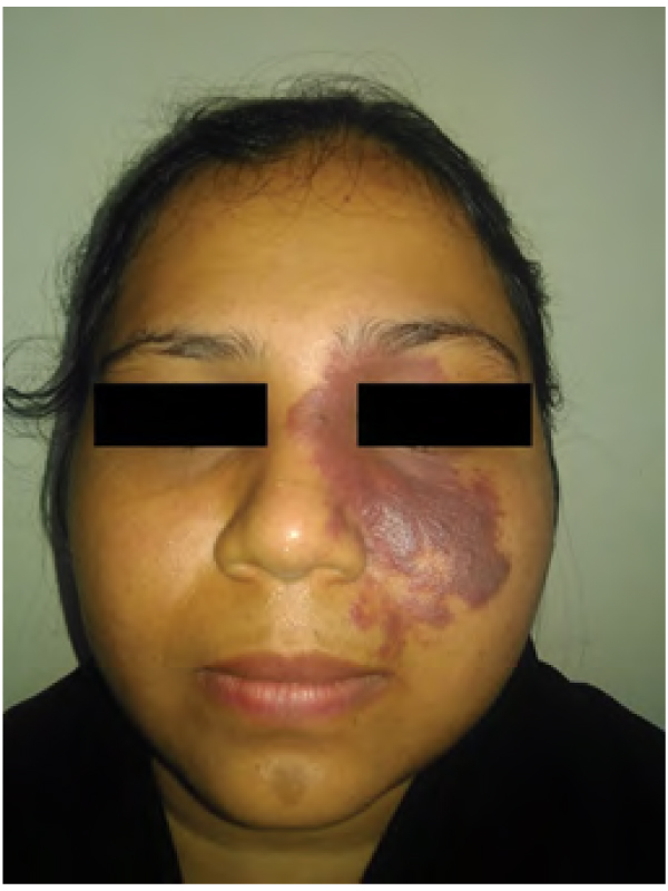 A Final Diagnosis of Port Wine Stain or Nevus Flammeus