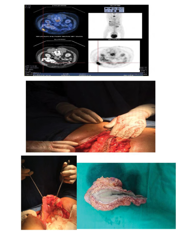 Port Site Metastasis Following Laparascopic Right Hemicolectomy